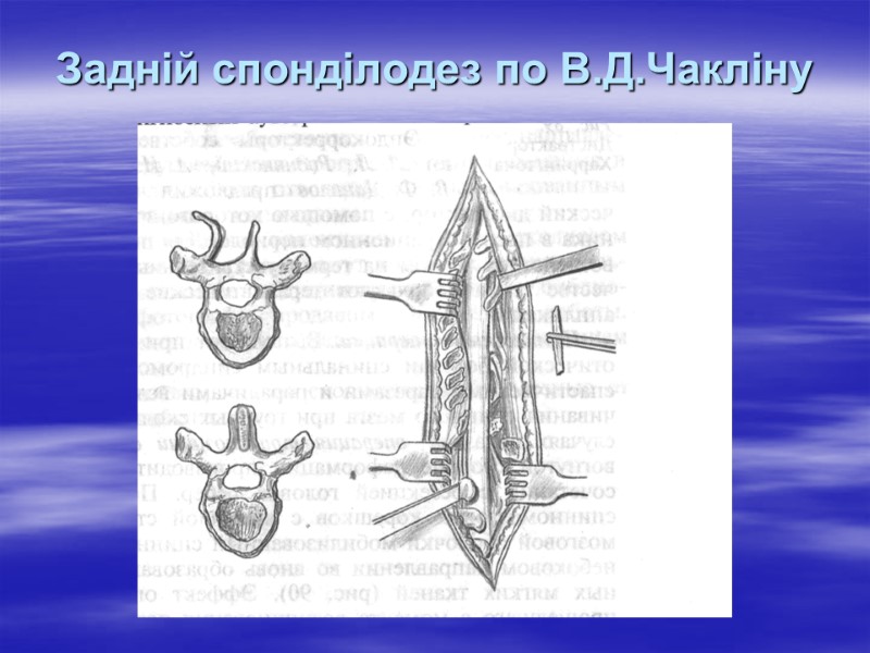Задній спонділодез по В.Д.Чакліну